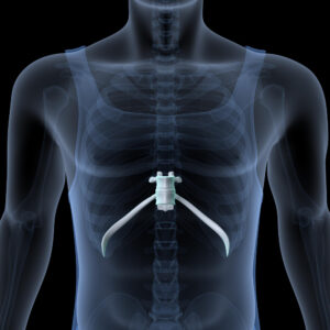 czym jest klatka piersiowa