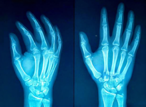 wyrostek rylcowaty czym jest